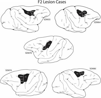 Greater Reduction in Contralesional Hand Use After Frontoparietal Than Frontal Motor Cortex Lesions in Macaca mulatta